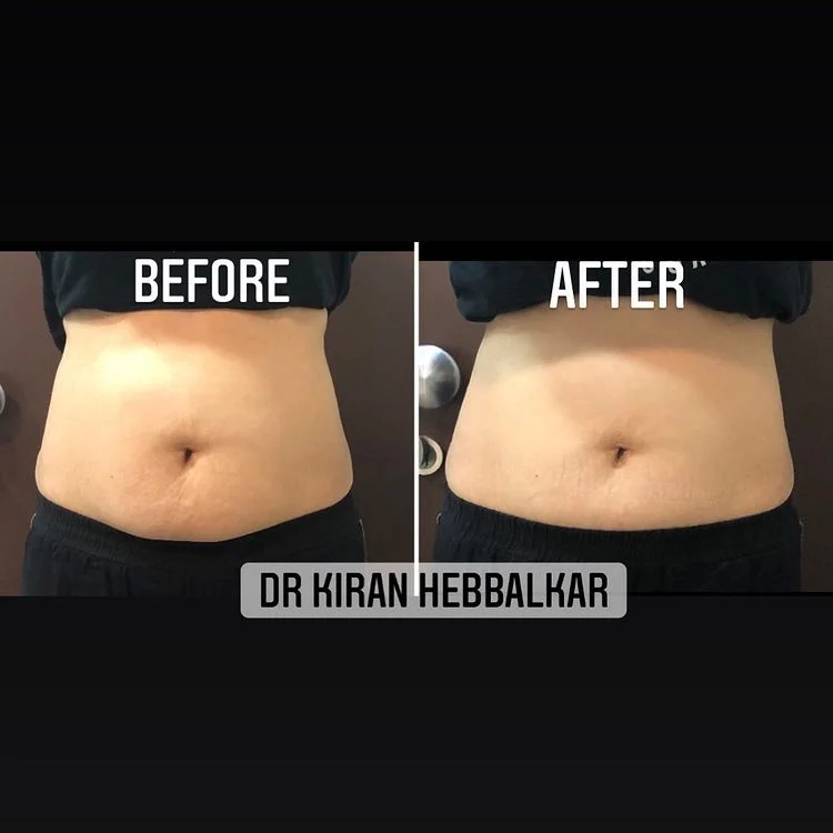 CoolSculpting_DrKiransClinic